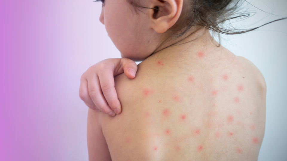 Get the Chickenpox Vaccine in Swindon