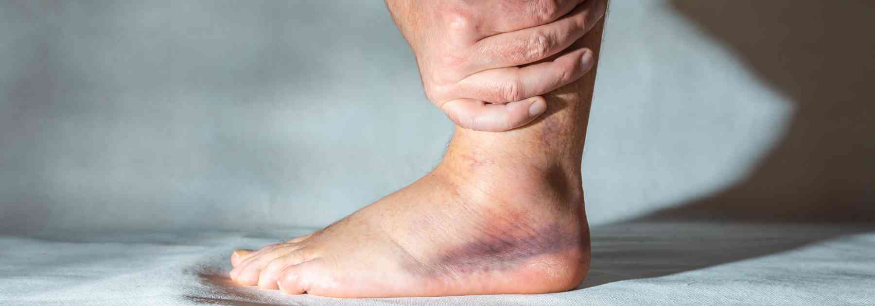 how to heal a sprained ankle overnight uk