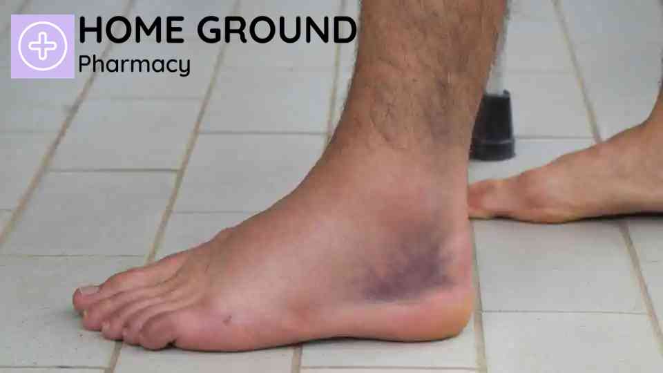 How to Heal a Sprained Ankle Overnight: Quick Recovery Tips