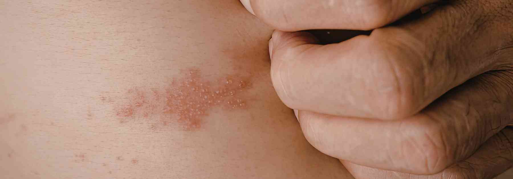 person scratching rash on their skin