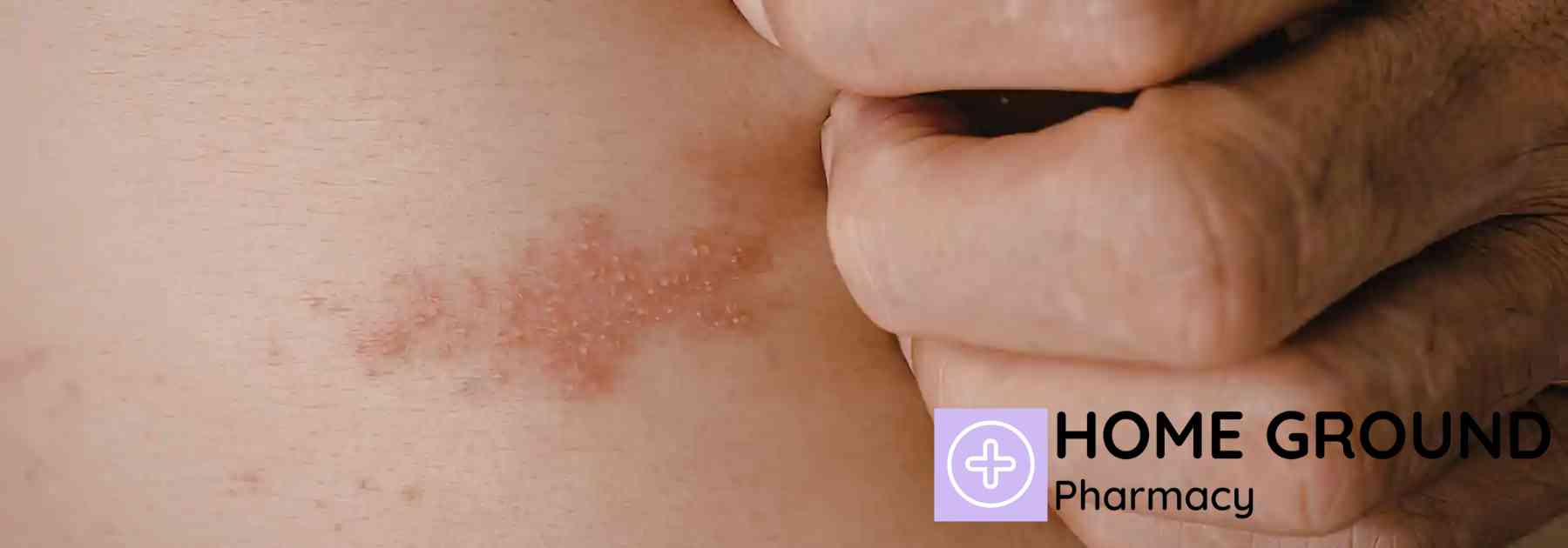 person scratching rash on their skin