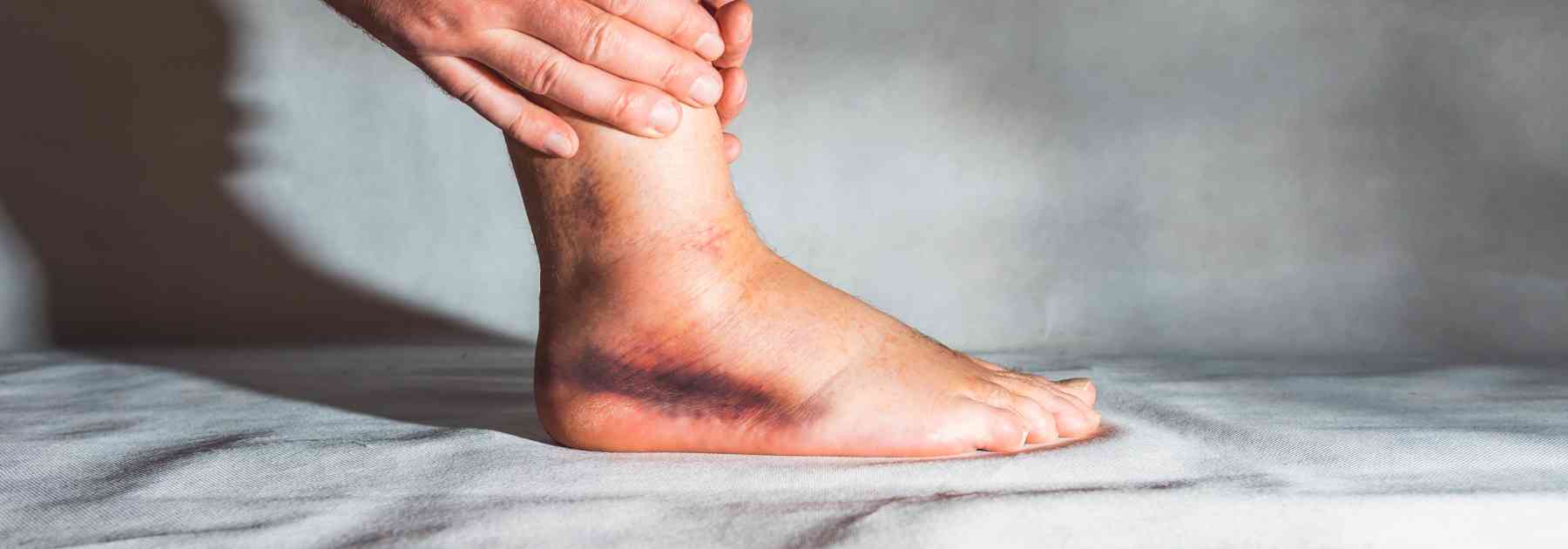 close-up of sprained ankle